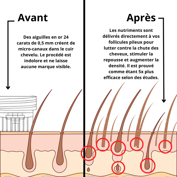 Traitement micro-infusion capillaire Elencia Infuse+